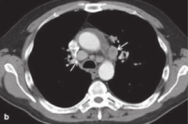 metástasis en el pulmón contralateral al tumor primario, derrame pleural neoplásico y/o modularidad pleural
