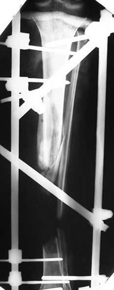 Ortopedia y Traumatología, Hospital Británico, Buenos Aires Marco teórico Los defectos óseos y tegumentarios en las secuelas de las fracturas expuestas representan un importante desafío en la cirugía