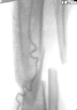 Año 74 Número 1 Marzo de 2009 Defecto segmentario de tibia de 14 cm 75 En el estudio radiográfico se observó un defecto óseo segmentario en la diáfisis tibial de 14 cm.