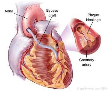 A un paciente de 55 años diagnosticado de cardiopatía isquemia severa se le ha indicado tratamiento quirúrgico de revacularización coronaria.
