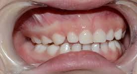 ARTÍCULO ORIGINAL Dentición caduca Cada etapa biológica tiene una autonomía y funcionalidad distinta.