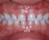 ARTÍCULO ORIGINAL se establezca un plano oclusal funcional en el que se desarrollara la segunda dentición, para que la erupción de molares 6 e incisivos permanentes se efectúen bajo estímulos