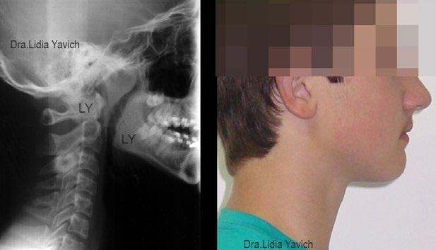 Secuencia de la ortodoncia tridimensional en la segunda fase del tratamiento de las