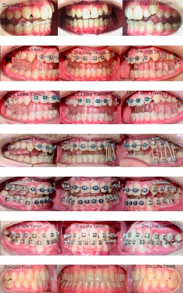 48 Parte de la secuencia de la ortodoncia tridimensional en la segunda fase del tratamiento de las patologías de la ATM, en este