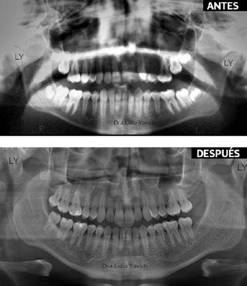 Radiografías panorámicas comparativas: antes del tratamiento y después de la finalización de la