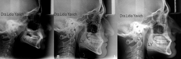 Radiografías laterales comparativas del paciente: en el inicio del tratamiento en oclusión