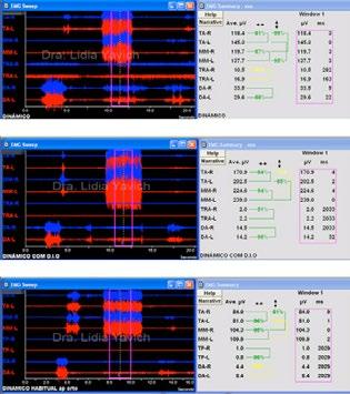 Comparación de los registros electromiográficos antes, durante y después del tratamiento.