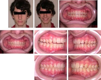 Alta controlada - Octubre 2015 Oclusión - Desoclusión CONCLUSIONES: En la evolución de este caso clínico, se comprueba la importancia del tratamiento en la primera dentición.