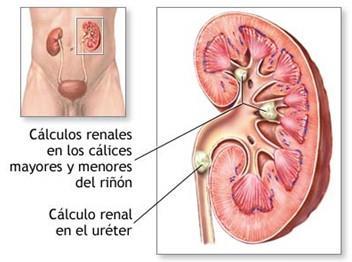 Litiasis renal Presencia de cálculos o conglomerados cristalinos (arenillas) en el interior de las vías urinarias, desde los cálices renales hasta la vejiga.