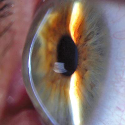 2 INFORMACIÓN PARA EL PACIENTE Por qué es tan importante tratar las enfermedades de la córnea? La córnea desempeña un papel fundamental en el ojo.