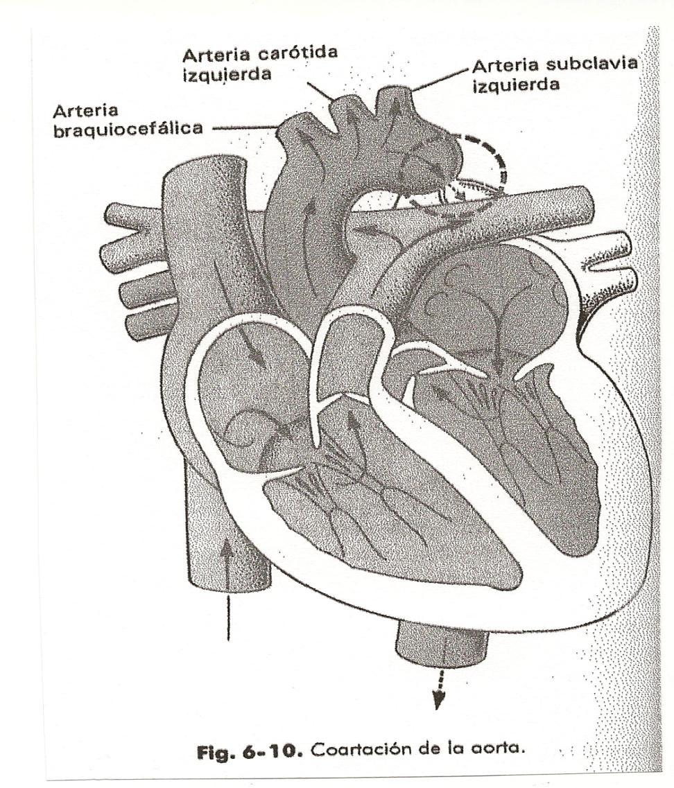 Coartación de la aorta Estrechez cerca de la inserción de conducto arterioso.