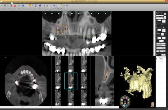 Simulación de implantes: posición del implante en modelos 2D y