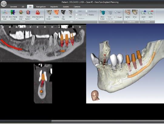Evaluación de la densidad ósea Posición del canal mandibular e