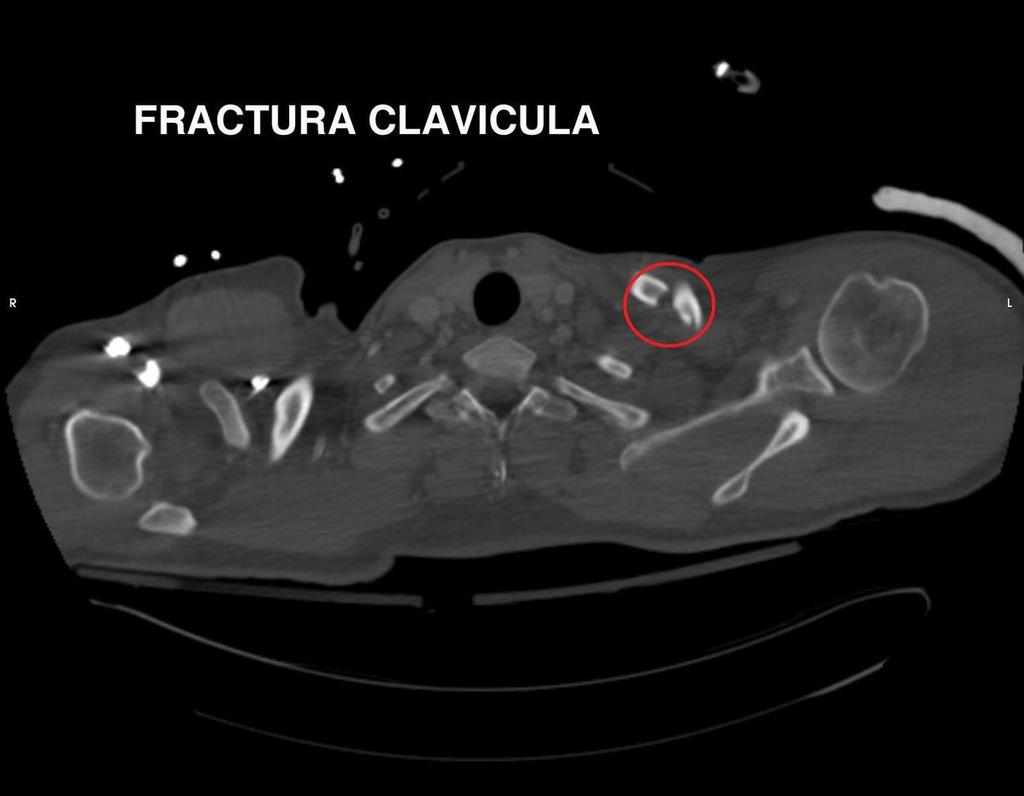 - la posterior puede asociarse a lesión de vasos mediastínicos, traquea y esófago. Frctura de clavícula: Fig. 6:.