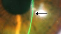 FILOSOFÍA DE ADAPTACIÓN El lente Onefit MED es soportado por la conjuntiva y el líquido contenido debajo de su superficie posterior.