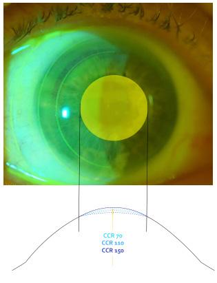 50D de astigmatismo corneal. Sin embargo, algunos perfiles corneales no se verán completamente corregidos por medio de la capa de líquido debajo del lente.