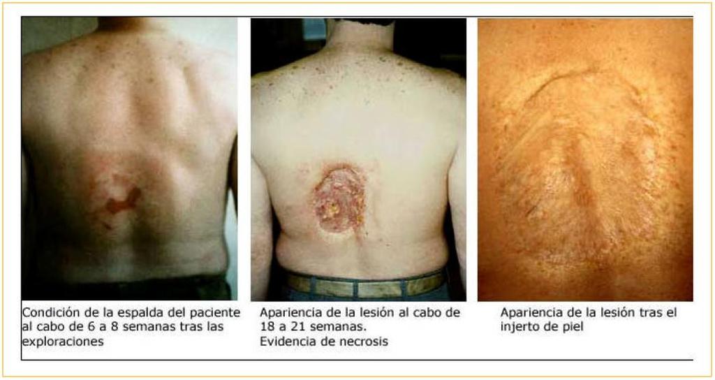 El riesgo de los efectos deterministas tempranos en RXD Lesión de piel radio-inducida.