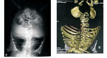 Montoya JH, Morales OL Biomédica 2009;29:25-32 Figura 4. Caso 4. a. Paciente de 3 meses: tórax y cuello cortos con extremidades de tamaño normal. b.