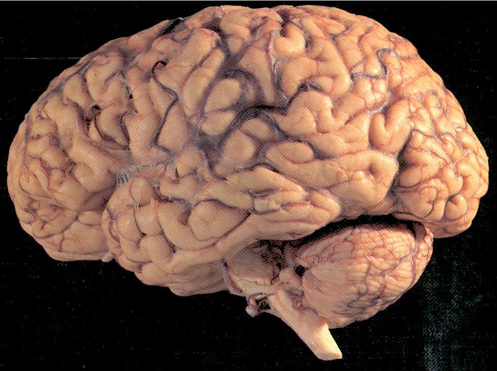 Daño cerebral explícito Disfunción Cerebral