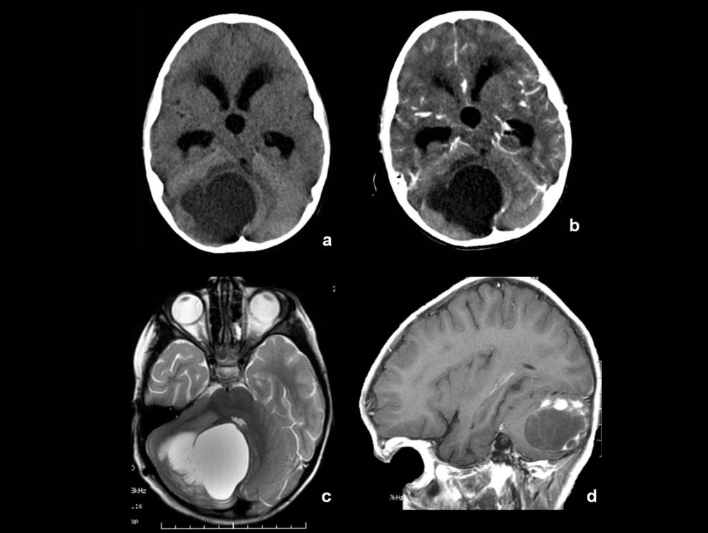 Fig. 3: Niño de 4 años con cefalea de 1 mes de evolución. Semiología típica en TC sin (a) y con contraste IV (b), y en imagen T2 de RM (c) y T1 con contraste (d).