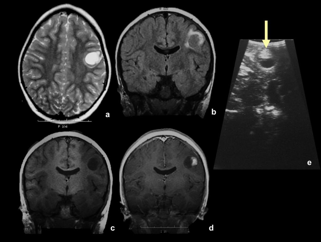 Fig. 15: Niña de 6 años con crisis focales en hemicara y miembro superior derecho. Tumor quístico con nódulo mural en área prerrolándica izquierda.