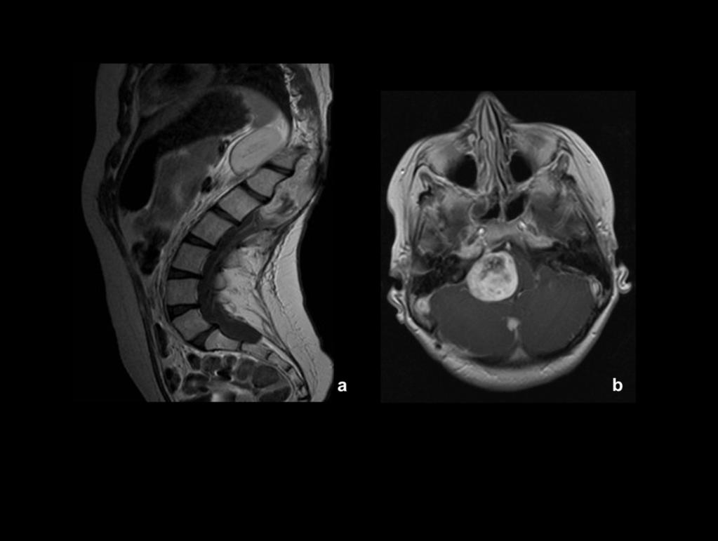 Fig. 21: Niña de 12 años diagnosticada a los 7 años de astrocitoma pilocítico de cono medular. Existe una alteración en la alineación del raquis por varias cirugías previas.