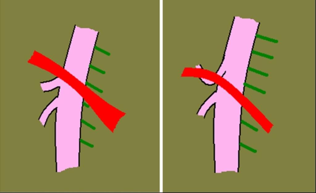 Fig. 8: Esquema de la relación entre el tronco celíaco y el ligamento arcuato.