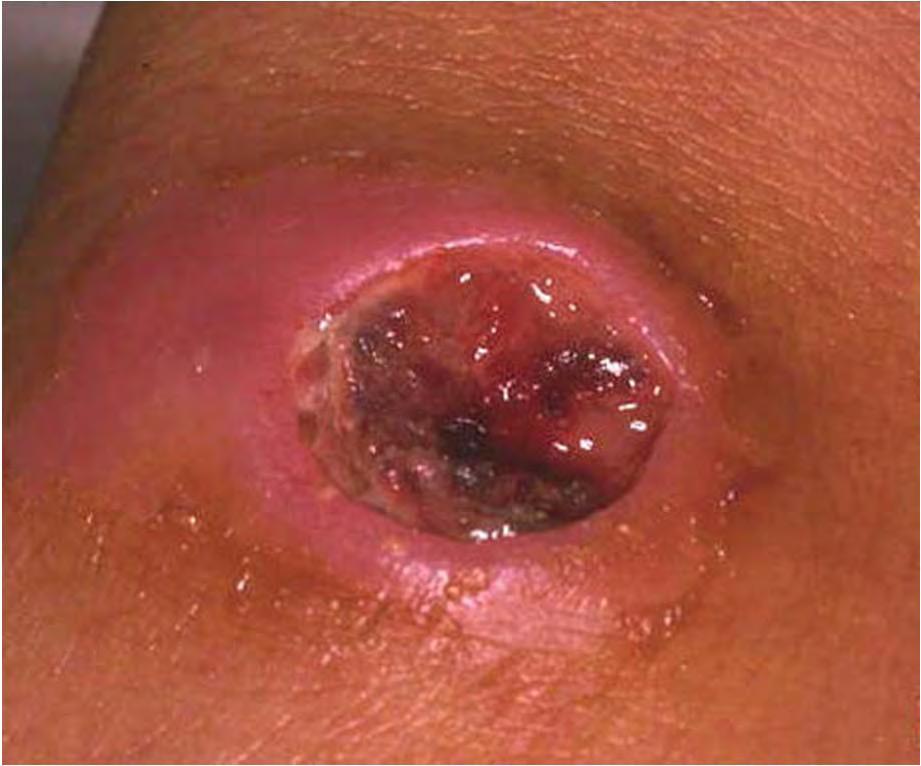 Carbunco cutáneo (pústula maligna) Pápula ulcera, edematosa, síntomas generales. Linfadenopatías y bacteriemia Mortalidad 20% Carbunco digestivo Ulceras en boca o esófago.