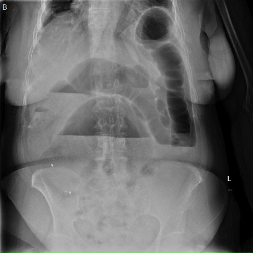 Fig. 3: Figura 2. Obstrucción de colon secundaria a neoplasia en sigma. A,B: Radiografía simple de abdomen (decúbito supino y bipedestación).