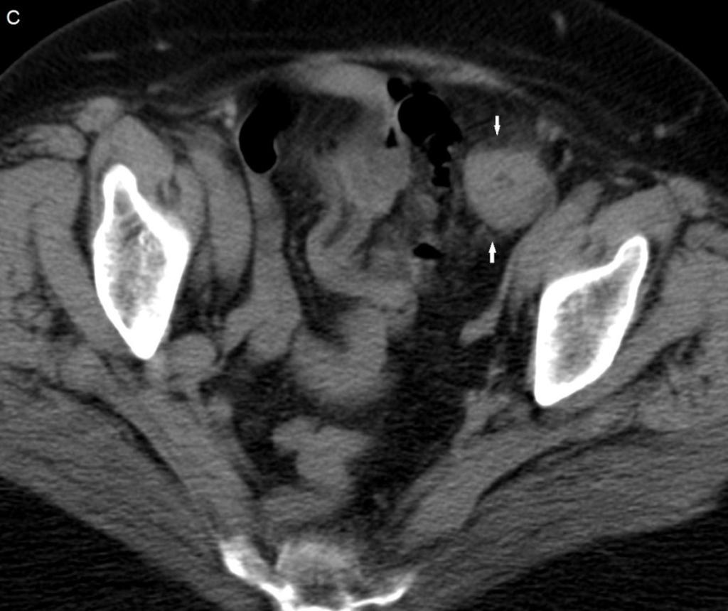 Fig. 4: Figura 2. Obstrucción de colon secundaria a neoplasia en sigma. A,B: Radiografía simple de abdomen (decúbito supino y bipedestación).