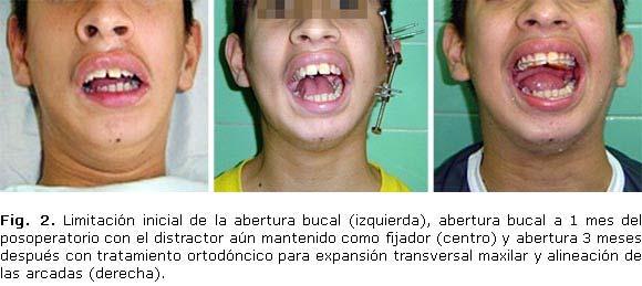 Los ejercicios de abertura bucal decrecieron en el tiempo hasta no ser realizados a partir del tercer año posoperatorio e igualmente el seguimiento por consultas de ortodoncia se dejó de realizar por