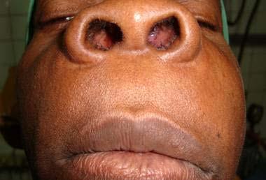 MEDISAN 2010; 14(9):2191 INTRODUCCIÓN Las neoplasias de origen odontogénico son lesiones que se originan a partir de restos embrionarios del órgano del esmalte que persisten en los maxilares.