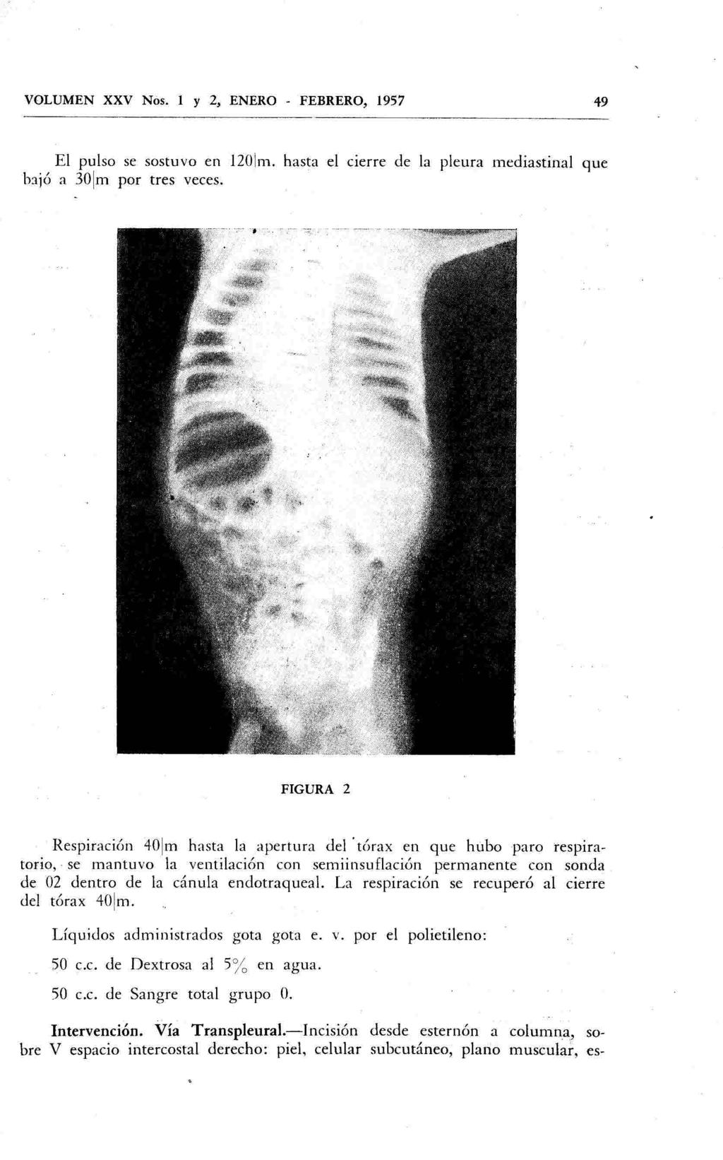 VOLUMEN XXV Nos. 1 y 2, ENERO - FEBRERO, 1957 49 El pulso se sostuvo en 1201m. hasta el cierre de la pleura mediastinal que bajó a 301m por tres veces.