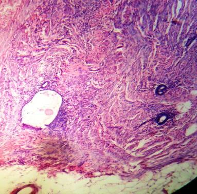 Figs. No. 4 y 5: Presencia de glándulas y estroma endometrial en la pared de recto sigmoides.