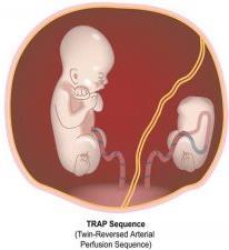 o Consecuencias feto receptor: alteración del desarrollo de estructuras como cabeza, corazón y EESS.