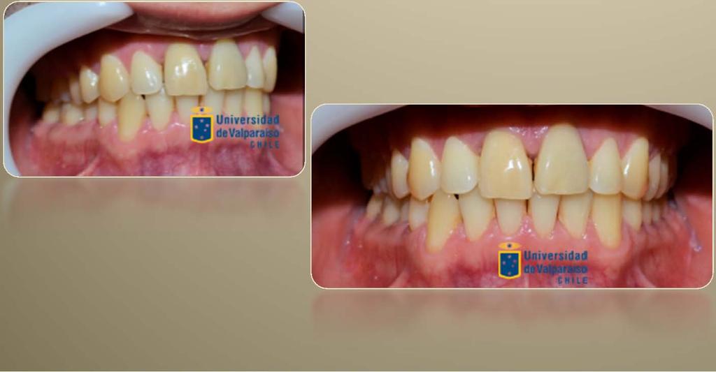 Salud Oral General Dentado total