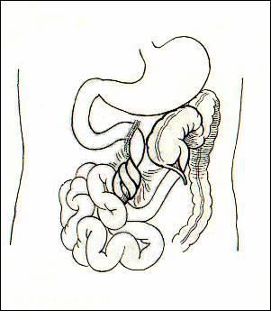 Figura No. 1 DISCUSIÓN El vólvulo de estómago es la complicación más frecuente provocada por malrotación intestinal en las primeras semanas de vida (1,2,5).