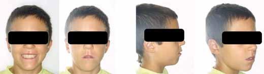 ARTÍCULO original La extracción seriada: Manejo ortodóncico y aplicación clínica (2ª parte) Caso n º 3: EL paciente varón de 9 años de edad, se encuentra en dentición mixta 1ª fase.