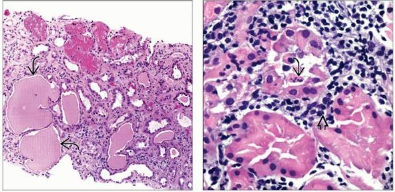 7, and > 3 g/d proteinuria, there is tubular injury with evident mitotic activity and an inflammatory infiltrate composed of mononuclear cells and plasma cells.