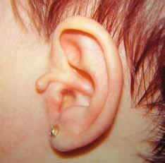 La agnatia es una falta de desarrollo de la mandíbula, que se acompaña de defectos en los huesecillos del oído medio y en la caja del tímpano.