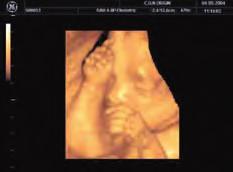 PLAntEAMIEnto EMBrIoLóGICo Fig. 1-10. Visión ecográfica en 3D de un feto humano a término. Obsérvense los detalles faciales.