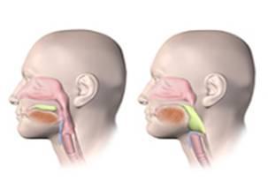 Trastornos que afectan la fase oral preparatoria de la deglución: Reducido cierre labial Dificultad en el movimiento de la lengua para formar el bolo Disminución en el rango o coordinación de los