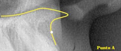 Utilizado inicialmente por Downs en 1948, se localiza en la zona más profunda de la concavidad anterior del hueso maxilar, representando el límite entre sus