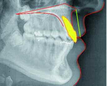Figura 13. La distancia lineal entre la comisura labial y la espina nasal anterior, corresponde a la longitud del labio superior. Fuente: Análisis de Ricketts.