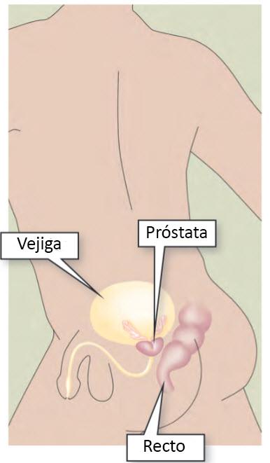 Manejo de síntomas tras un cáncer de próstata Problemas de intestino Si usted tiene problemas de intestino como consecuencia de la Radiación, posiblemente le resulte vergonzoso.