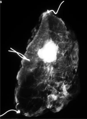 Radiografía de especímenes de cuadrantectomía en cáncer de mama etapas I y II 9 Figura 1. Espécimen de cuadrantectomía en la que se evidencia claramente el tumor primario de 2.