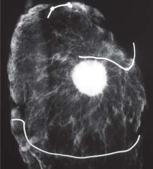 10 Mainero Ratchelous FE y cols. Figura 5. Radiografía de carcinoma ductal de 1.9 cm asociado a microcalcificaciones pleomórficas dispersas por fuera del área nodular principal que medía 0.