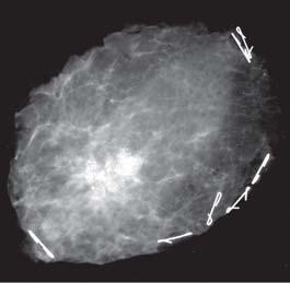 El nódulo tumoral en el centro de la pieza operatoria es visible, sin embargo es difícil delimitar el margen de la porción derecha de la imagen debido al parénquima mamario denso regional. (Caso 12).