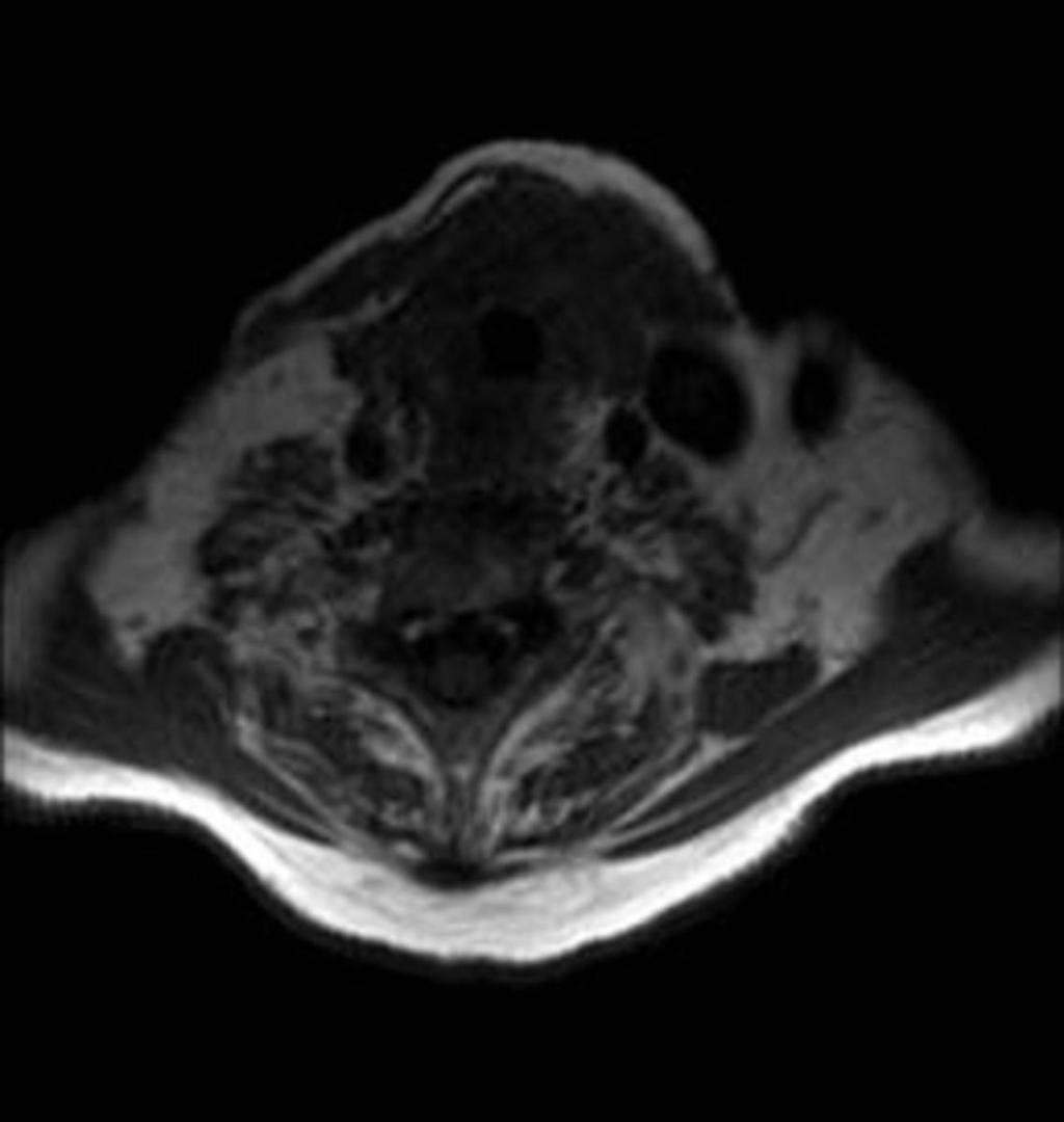 Fig. 10: Mediastinitis fibrosante alrededor de la carótida y subclavia izquierdas. Fig. 11: Varón de 83 años con tiroiditis de Riedel en biopsia tiroidea.