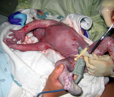 PINZAMIENTO DEL CORDÓN Colocar al recién nacido sobre el vientre de la madre, secarlo y arroparlo. No debemos cortar el cordón nada más nacer.